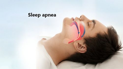 Sleep Apnea - Cara Mengobatinya Ada banyak